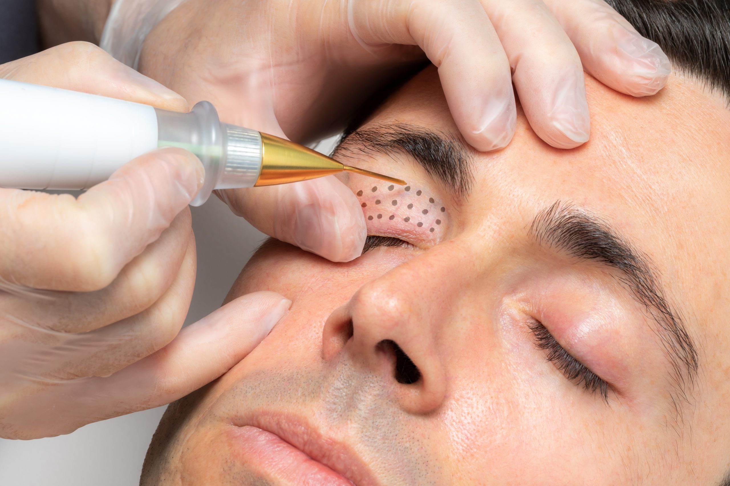 Plasma-Pen Seminar in Leonberg